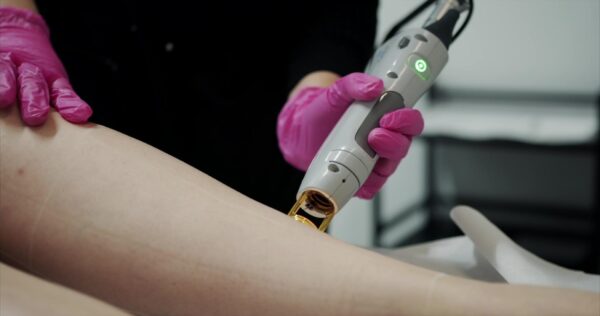 Laser Skin Rejuvenation Training gentle max pro laser device being used for laser hair removal on the leg