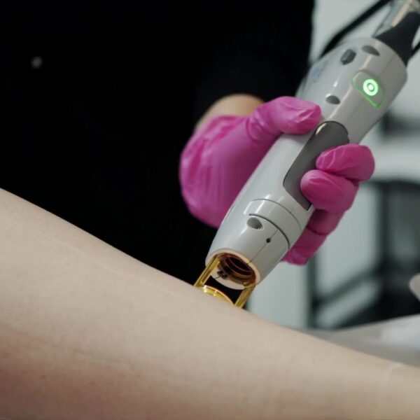 Laser Skin Rejuvenation Training gentle max pro laser device being used for laser hair removal on the leg