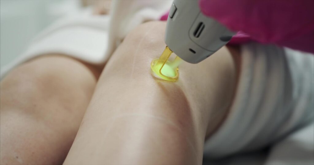 LASER HAIR REMOVAL ON THE LEGS IN MONTREAL SPA LAVAL