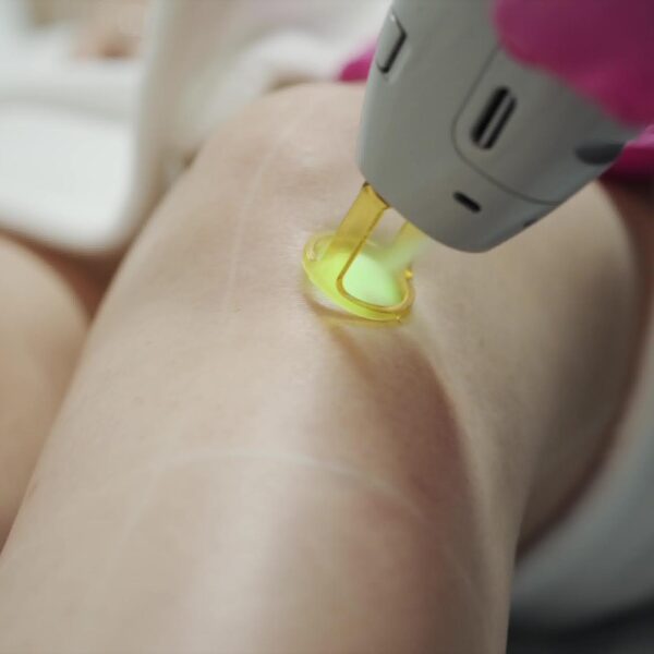 LASER HAIR REMOVAL ON THE LEGS IN MONTREAL SPA LAVAL