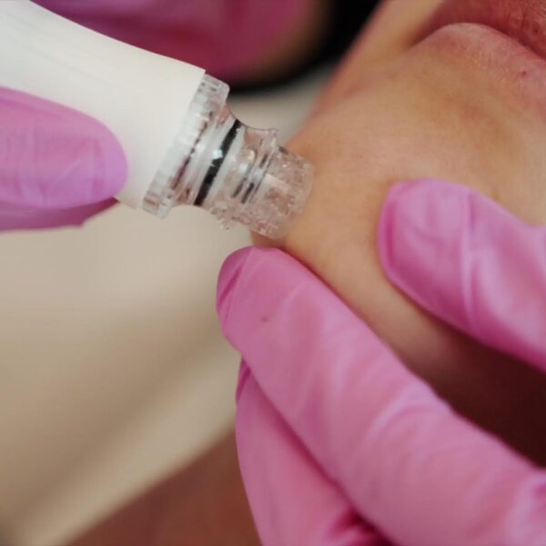 hydradermabrasion hydrafacial of the chin to remove skin problems