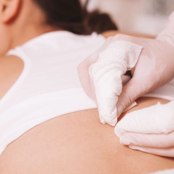 back facial extractions to remove blackheads on the backside