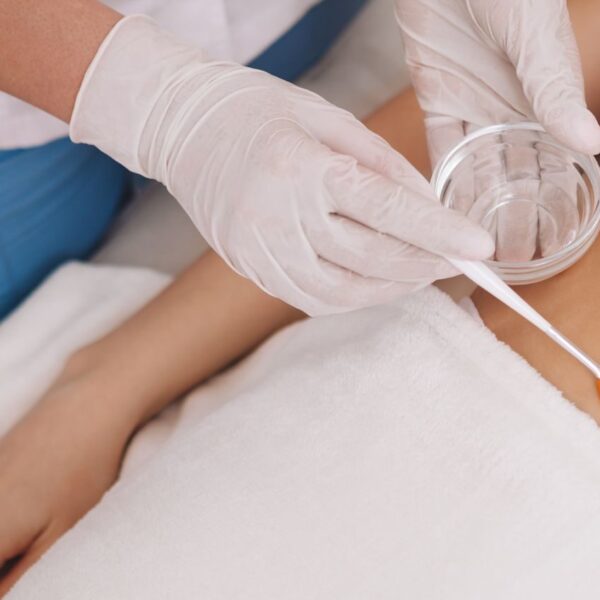 chemical peel treatment on the body to reduce scars or stretch marks