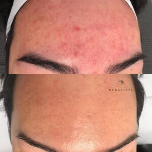 client results after new age spa skin treatment in montreal and laval