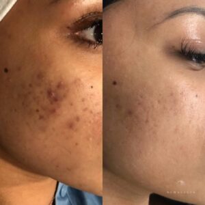 les résultats des clients du spa new age montreal et laval pour les problèmes de peau résolus par le traitement du visage