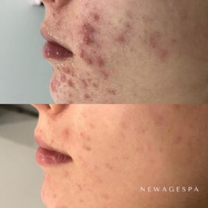client results from facial cleared skin problems at new age spa montreal and laval acne