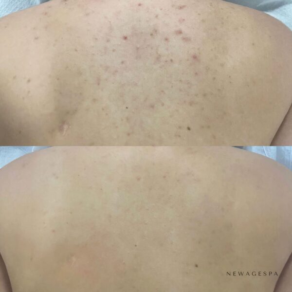 back treatment skin transformation