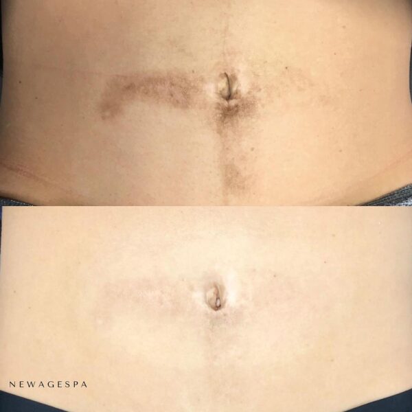 client results from facial cleared skin problems at new age spa montreal and laval
