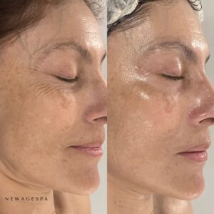 résultats de la cliente du traitement facial des problèmes de peau au spa new age de montréal et laval peau hydratée