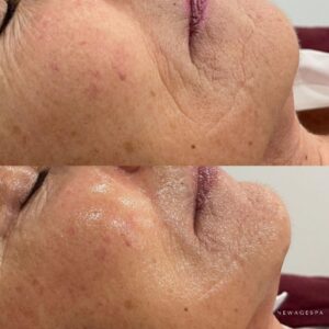 résultats d'un traitement facial des problèmes de peau au spa new age montreal et laval anti-aging