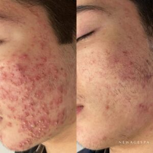 les résultats des clients du spa new age montreal et laval acne pour le traitement facial des problèmes de peau