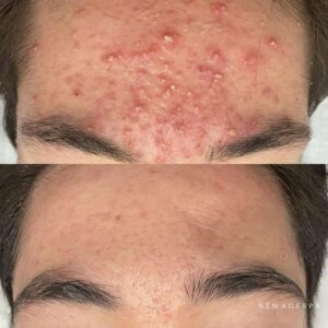 les résultats des clients du spa new age montreal et laval acne pour le traitement facial des problèmes de peau