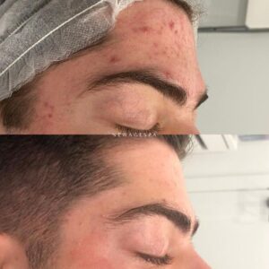 l'acné sur le visage et le front disparaît grâce aux soins du visage du nouvel âge