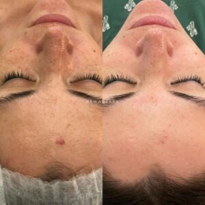 sun spots dark spots from new age spa facial treatment picture of results with happy client