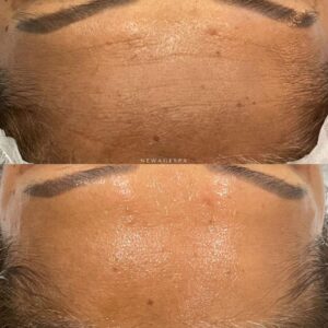 new age spa réduction des rides sur le front résultats photo par new age spa