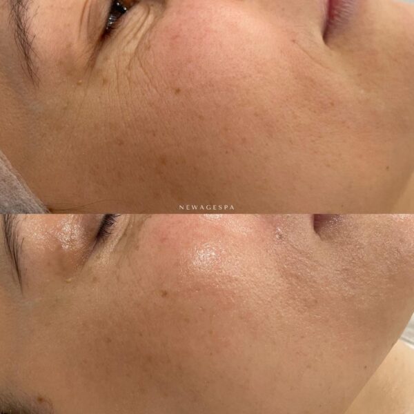 wrinkles under eye crows feet removal results pic from new age spa
