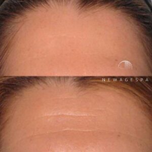 résultats des clients sur les problèmes de peau du visage au spa new age de montréal et laval