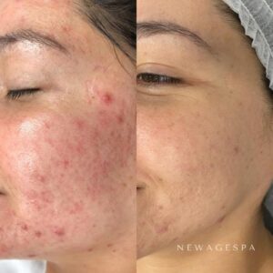 résultats des clients sur les problèmes de peau du visage au spa new age de montréal et laval