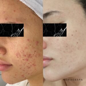 résultats des clients sur les problèmes de peau du visage au spa new age de montréal et laval