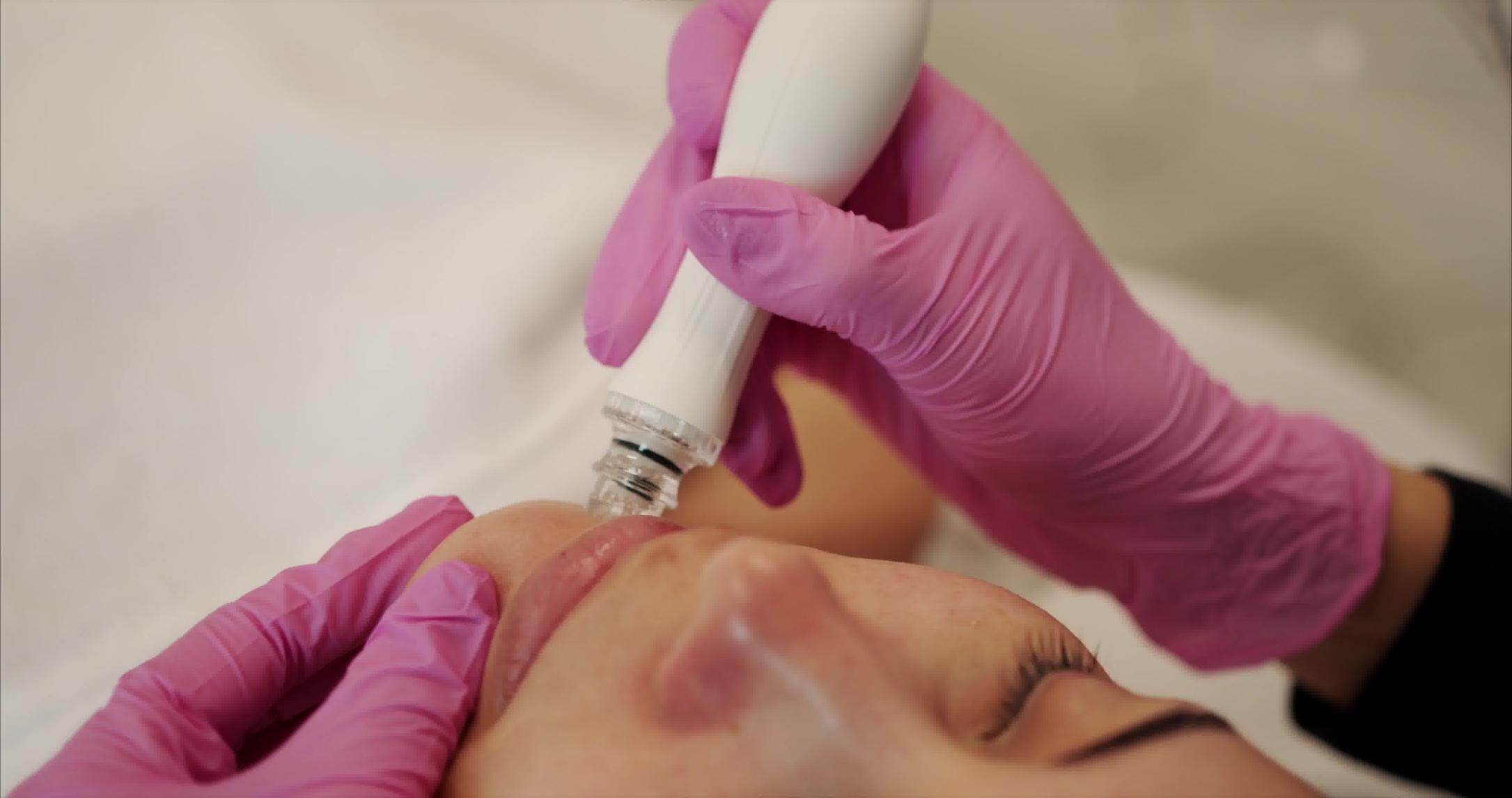 microdermabrasion in Montreal and Laval
