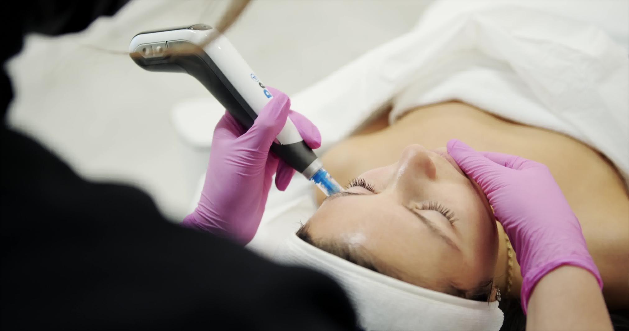 microneedling dp4 on client face in Montreal and Laval