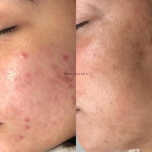 Résultats de l'acné sur la peau asiatique