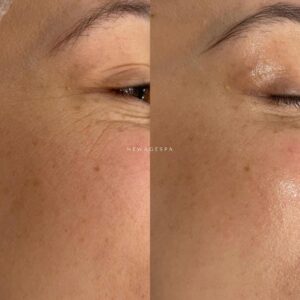 traitement des rides résultats photo new age montreal