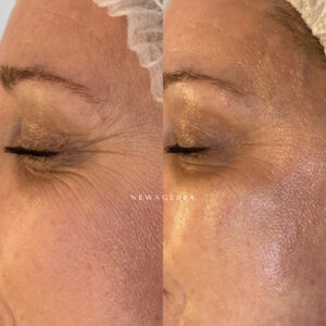 wrinkles treatment anti aging montreal