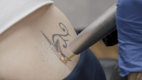lasertatooremoval