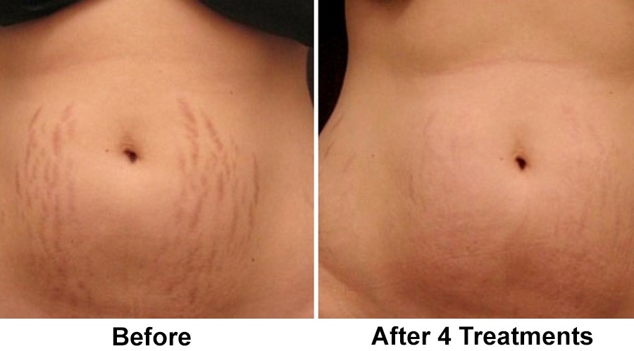 Résultats du microneedling sur les vergetures
