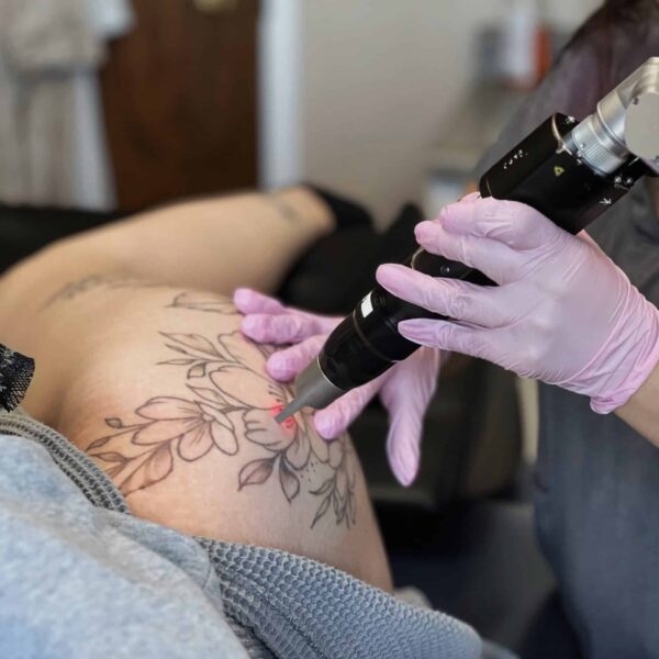 Laser - détatouage - grand format 12x12