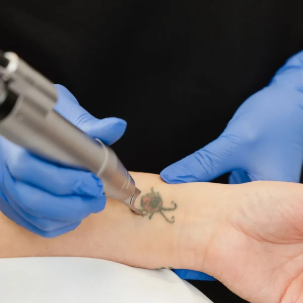 Laser - Détatouage - Petit 4x4"